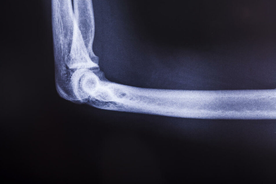 Vitamin D Deficiency Ages Bone, Raises Fracture Risk | WholeFoods Magazine