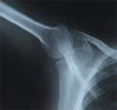 Bone X-Ray