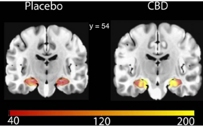 Image highlighting the difference in hippocampal CBF after CBD or placebo, published in research paper